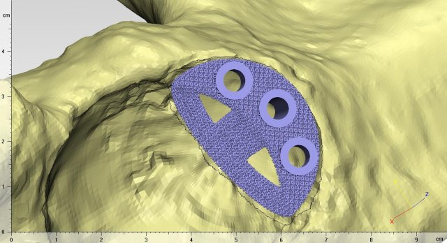 individual acetábulo aumentar 3d impressão modelo in biologia 3dexport operação cirurgia medicamento médico osso impant impresso sla oi titânio bioengenheiro pn 3D print model - Mito3D