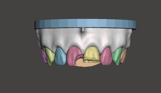 3d dentaire Douane modèle précédent classe iv vi segmenté dentiste émail dents dent dentisterie composite molaire dentition bouche canine canin incisif anatomie science 3d print model - Mito3D
