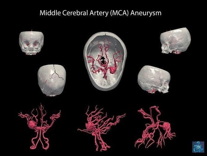 3d model middle cerebral artery aneurysm brain medicine anatomy human science education biology 3d print model - Mito3D