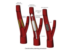 3d printable carotid artery stenting procedure diorama stent medicine medical biomedical educational education surgery angioplasty blood vessel heart coronary cardiology disease catheter bypass science biology 3d print model - Mito3D