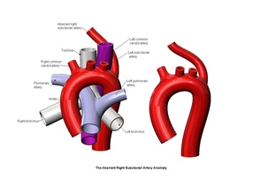 anormal köprücük altına ilişkin arter anomali karotis ilaç tıbbi biyomedikal eğitici eğitim kardiyoloji hastalık yazdırılabilir diyorama arsa insan kalp trakea aort kardiyovasküler pulmoner bilim biyoloji 3d print model - Mito3D