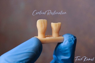 central tooth restoration v2 composite waxup dentistry dental incisor teeth dentist maxillary mandibular print 3dprint scan upper cavity anatomy science biology 3d print model - Mito3D