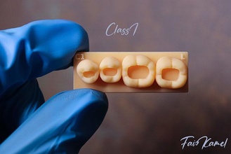 classe 1 mandíbula quadrante cavidade composto Encerar dental dente anatomia molar superior incisivo incrustação onlay impressão 3dprint Ciência biologia 3d print model - Mito3D