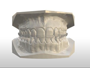 coverage occlusal splint canine guidance dental teeth bite medical 3d print lab cad 3shape dentistry mouth tooth science 3d print model - Mito3D