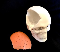 craniofacial implant medical maxillofacail surgery anatomy science medicine body head skull 3d 3dprint dentistry fracture biology 3d print model - Mito3D