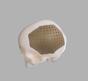 kafatası kusur protez calvarium aşılama dikizlemek tıbbi anatomik Dicom ameliyat osteotomi Bilim 3d print model - Mito3D