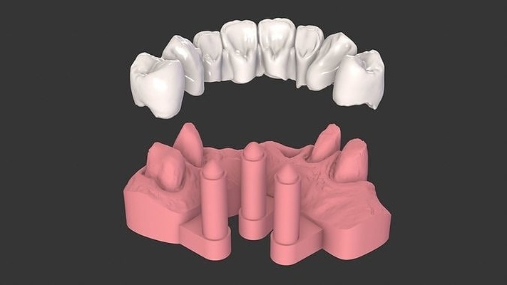 diş anatomi köprü gerçek tıbbi durum kılıf hekimliği doktoru oral ilaç çene baskı izi 3dprinting takma bilim insan kemik dişlenme ağız biyoloji 3d print model - Mito3D