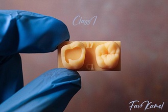 Dental Klasse 1 Oberer höher Kiefer Zahn Modelle zusammengesetzt Wachs auftragen Zahnarzt Zahnheilkunde Schneidezahn Kieferorthopäde Wurzel Hohlraum Dentin Fruchtfleisch Oberkiefer Unterkiefer Anatomie Onlay 3d 3dprint 3d print model - Mito3D