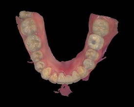 dental embutido modelo dientes odontología mella boca ciencias biología 3d print model - Mito3D