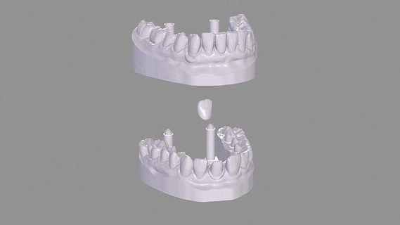 dental imprimível realista mandíbula dente dentes dentista médico boca medicamento molar prótese dentária maxilar Ciência odontologia detalhado anatomia impressão 3dprint médica caso bainha 3d print model - Mito3D