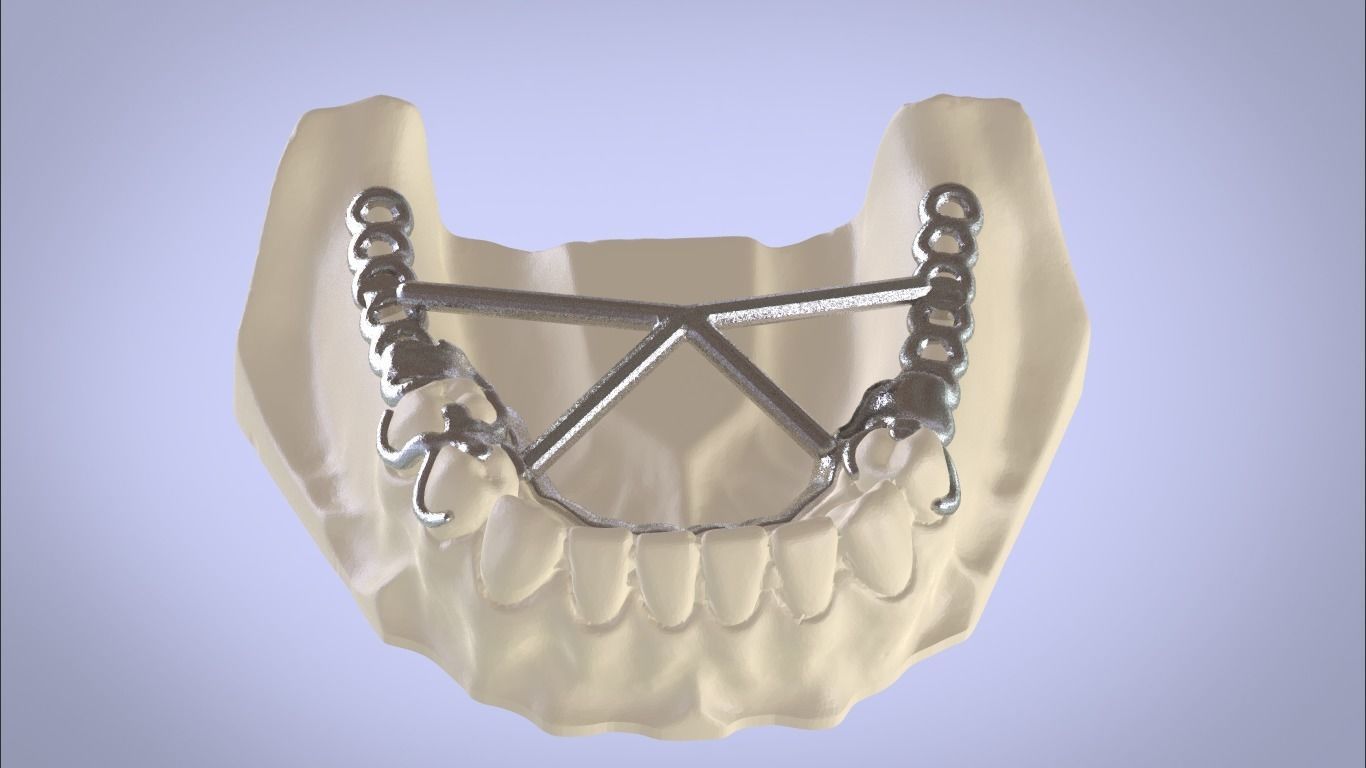 digital 3d removível parcial dentadura dental obj stl ciência dente dentista rpd 3shape 3D print model - Mito3D