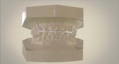numérique activateur appareil 3shape lamagie laboratoire 3d keyhot pro 3dcad rendre keyshotpro branches éclisse médical dents dent science 3shapeappliancedesigner orthodontie fonctionnel 3d print model - Mito3D