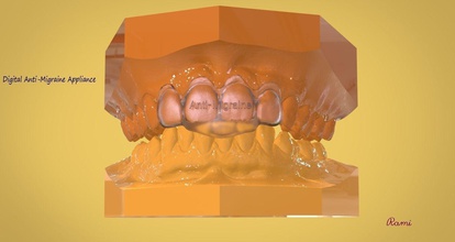 digital anti-migraine appliance dental sleep medical 3d orthodontics 3shape cad keyshot rhino obj 3dpdf science 3d print model - Mito3D