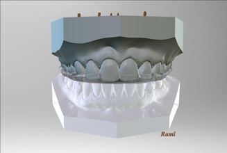 digital bite-guard appliance dental cad sl1 prusa stl obj fbx scan 3d 3dprinters medical equipment teeth medicine tooth sleep rami dentistry science 3d print model - Mito3D
