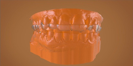 digital bite raising splint 3d orthodontics cad dental 3shape science 3shapesplint splintdesigner cadcam rami labmagic3dcad sleepmedicine dentistry 3d print model - Mito3D