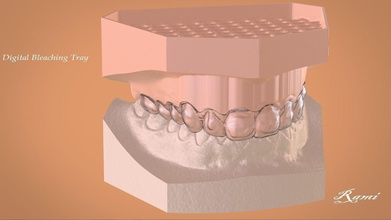 digital de branqueamento bandeja ciência dental 3shape keyshotpro keyshot 3d 3dprinting o cad dente tala outros 3d print model - Mito3D