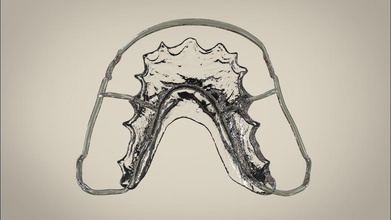 digital circumferential wrap-around retainer scanned models dental splint digitized science medical dentistry dentist medicine 3d print model - Mito3D