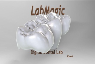 digital contorno ponte modelo exocad 3shape cafajeste 3d imprimível prototipagem médico dental dente laboratório cadeado dentário keyhot dentes Ciência 3d print model - Mito3D