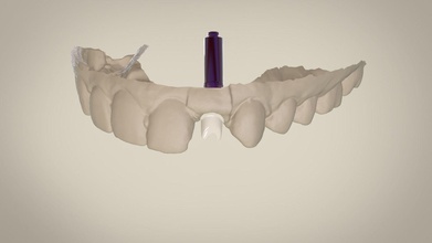digitale personalizzato dentale moncone cad 3d 3dprinters impianti medico scienza impianto ammaccatura odontoiatria dentista medicinale 3d print model - Mito3D