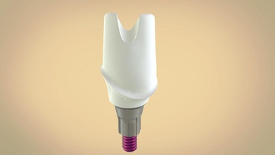 digital screw retained abutment implant tooth custom 3d 3shape keyshot dental 3dprint cnc milling tech medical science 3d print model - Mito3D