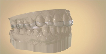 digital dental mordedura entablillar médico 3d canalla stl orto ciencias odontología medicamento dentista ortodoncista cad3d bruxismo 3dprinting 3d print model - Mito3D