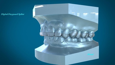 digital dental dayguard splint teeth denture cad 3shape rami orthodontics dentistry care medical equipment science enamel gum 3d print model - Mito3D