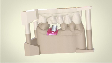 digitale dentale impiantare modello posizionamento guida denti odontoiatria cad 3d laboratorio scienza dentista medicinale ammaccatura 3d print model - Mito3D