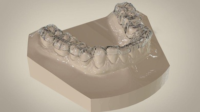 digital dental overlay hard splint dentistry cadcam splints orthodontist science 3shape 3d 3dprinting lab medical 3d print model - Mito3D