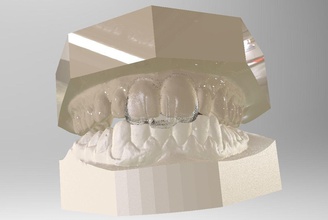 digital dental nti splint science cad orthodontics labmagic3d cadcam splints other 3d print model - Mito3D