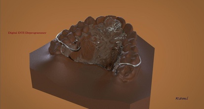 digital dti deprogrammer aparato la ciencia 3d dental cad ortho férula el láser sinterización 3dprint otros 3d print model - Mito3D