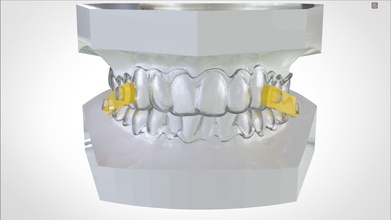 digitale elastico mandibolare avanzamento dispositivo dentale dente protesi medico 3shape 3d stampa keyshot scienza odontoiatria russamento anti dormire cad 3d print model - Mito3D