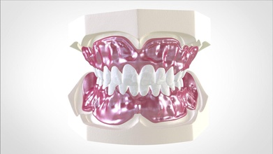 digital dentures gluedin teeth manual reduction dental tooth medical keyshot 3shape 3d cad dentistry cnc milling 3dprinting dentist science 3d print model - Mito3D