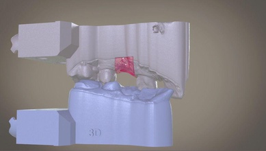 digital modelo de implante tejidos blandos la ciencia dientes 3d cad cnc pilar 3shape 3dscanned odontología imprimible tech médica cam dentista implantología lab clínica otros 3d print model - Mito3D