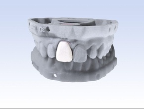 Digital Schneidezahn Furnier Modell Dental cad Zahnheilkunde 3d 3dprinting 3shape Keyshot Geäst Harz medizinisch Nocken Zahn Zahnarzt Mund Wissenschaft 3d print model - Mito3D