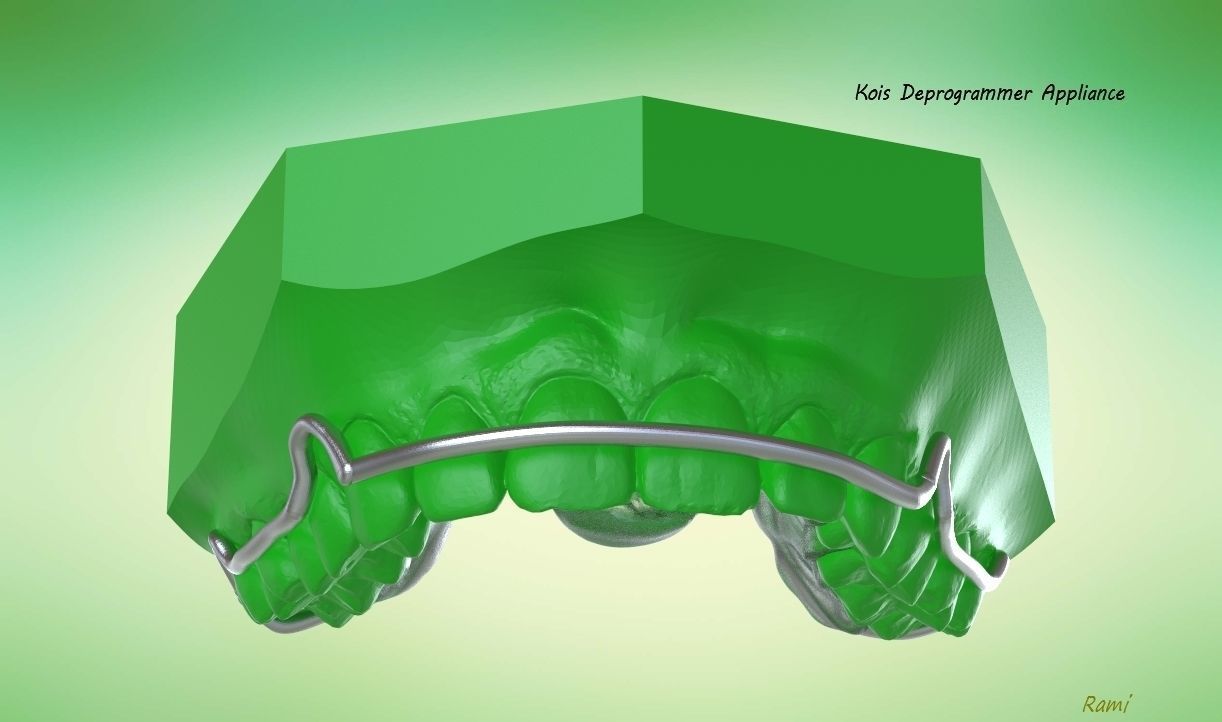 digital kois desprogramador utensílio orto dental cafajeste 3shape keyhot dente dentes médico 3d escaneado anatomia boca dentadura ciência rinoceronte 3D print model - Mito3D