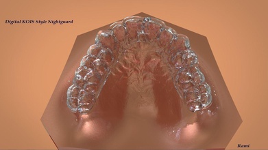 digital kois style nightguard dental cad orthodontics dentures tooth teeth 3sshape rendering dentallab science dentistry dentist 3d print model - Mito3D