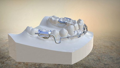 digital lip bumper appliance miniatures challenge dental dentistry dentallab orthodontics keyshot solutions cad science technology scanned scannedmodel model tooth medical dentist medicine 3d print model - Mito3D