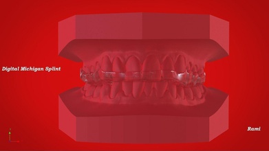 digital michigan schiene 3d drucken dental cad zahnersatz 3shape abonnieren 3dcad geäst zahnheilkunde keyshot nashorn wissenschaft 3d print model - Mito3D