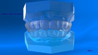 digital orto dente posicionador ciência dental tala prótese o sono digitalizado modelos a boca língua anatomia humanos os dentes gum outros 3d print model - Mito3D