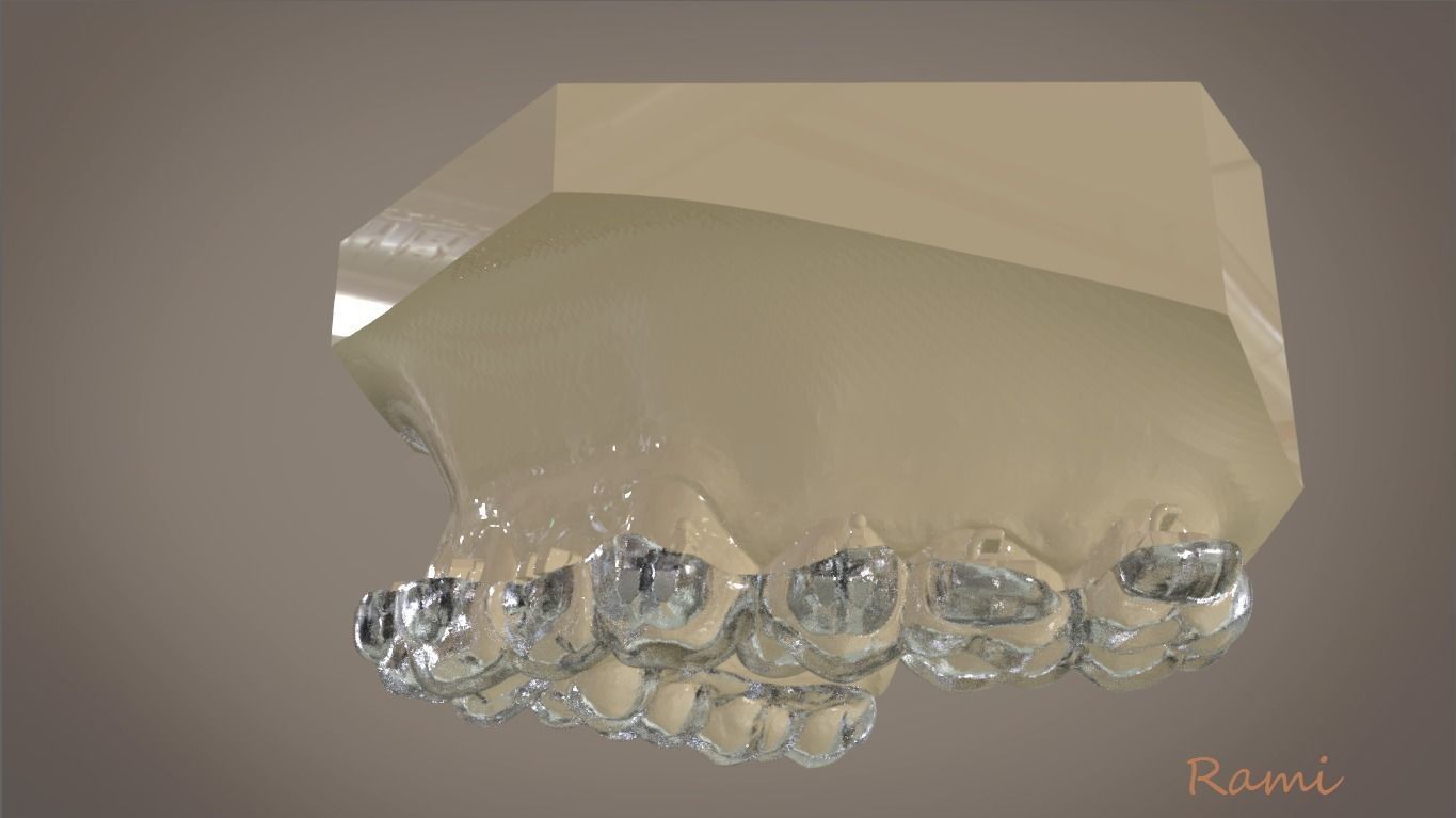 digital orthodontic indirect bonding tray dental 3d medicine dentist medical dentistry 3shape cad 3dprinting science orthodontist incisor 3D print model - Mito3D