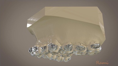 digitale ortodontico indiretto incollaggio vassoio dentale 3d medicinale dentista medico odontoiatria 3shape cad 3dprinting scienza ortodontista incisivo 3d print model - Mito3D