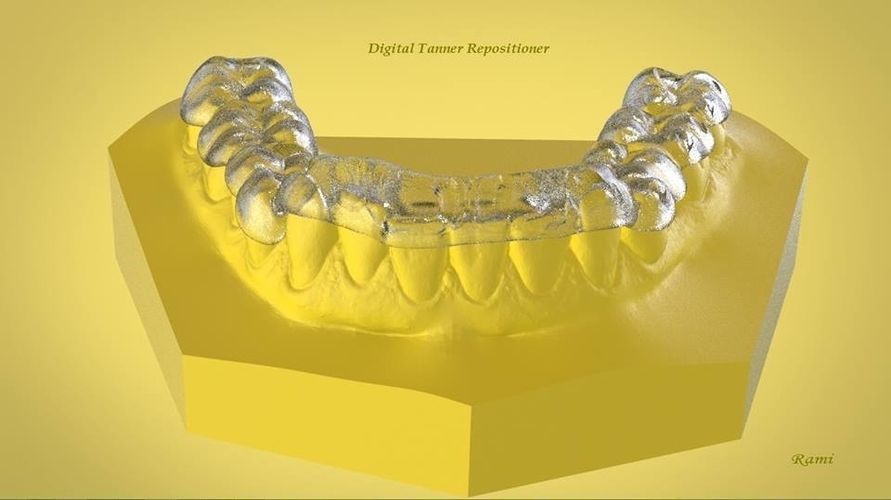 digital ortho tanner repositioner dental cad teeth 3d 3dcad dentistry 3dprint printable medicine cuspid enamel tooth bitesplint science 3D print model - Mito3D