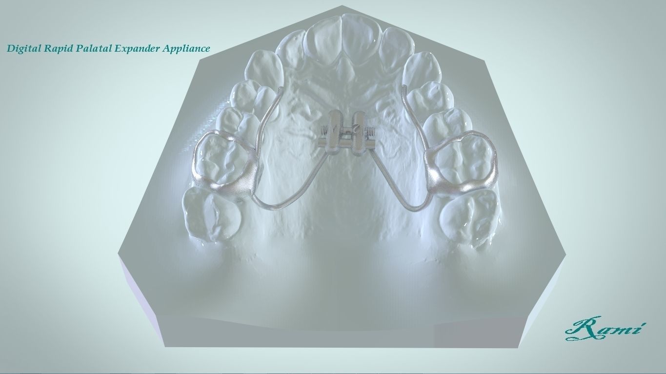 digital rapid palatal expander science 3d tooth denture splint 3dscanning 3shape keyshot dental appliance expnder sintering models medical other 3D print model - Mito3D