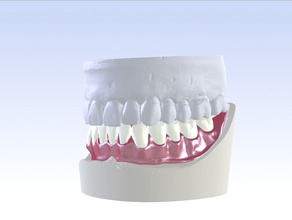 digital single kiefer prothese dental cad lächeln zähne mahlen zahnersatz labor 3shape 3d zahnheilkunde zahnarzt mund druckbar wissenschaft 3d print model - Mito3D