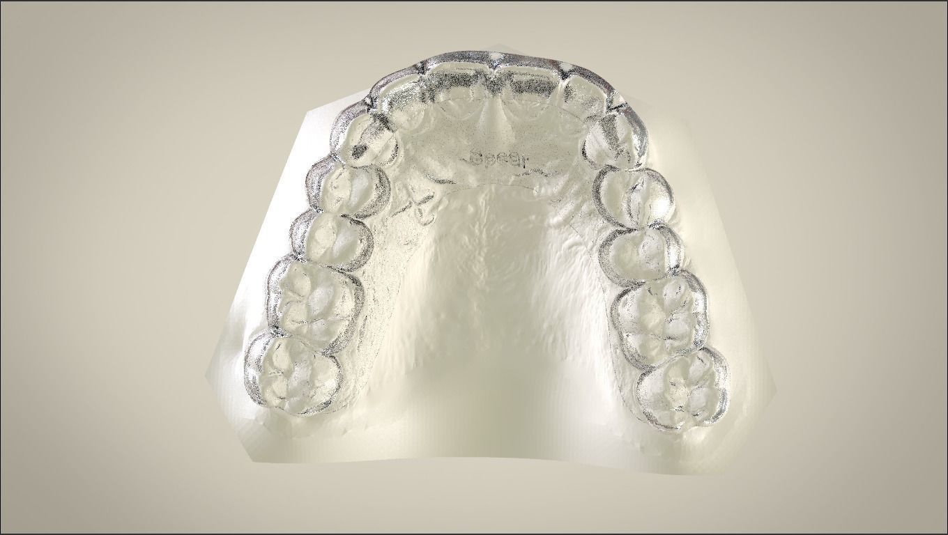 digital spear deprogrammer splint science orthodontics dental labmagic3dcad teeth splints other 3D print model - Mito3D
