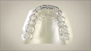 digital Speer deprogrammiererin schiene Wissenschaft die Kieferorthopädie dental labmagic3dcad Zähne Schienen andere 3d print model - Mito3D
