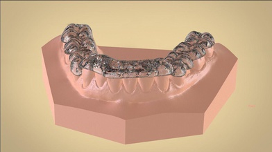 digitale tanner orto riposizionando stecca ortodonzia apparecchio scienza medico scansionato scanner scansione digitalizzare cad dente denti keyshot dentale tecnico tecnica 3d print model - Mito3D