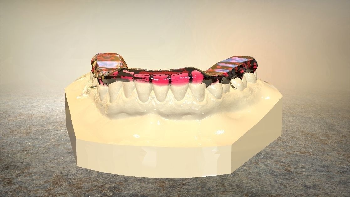 digital tanner splint orthodontics cad dentistry science 3shape printable cam 3d 3dprinters medical 3D print model - Mito3D