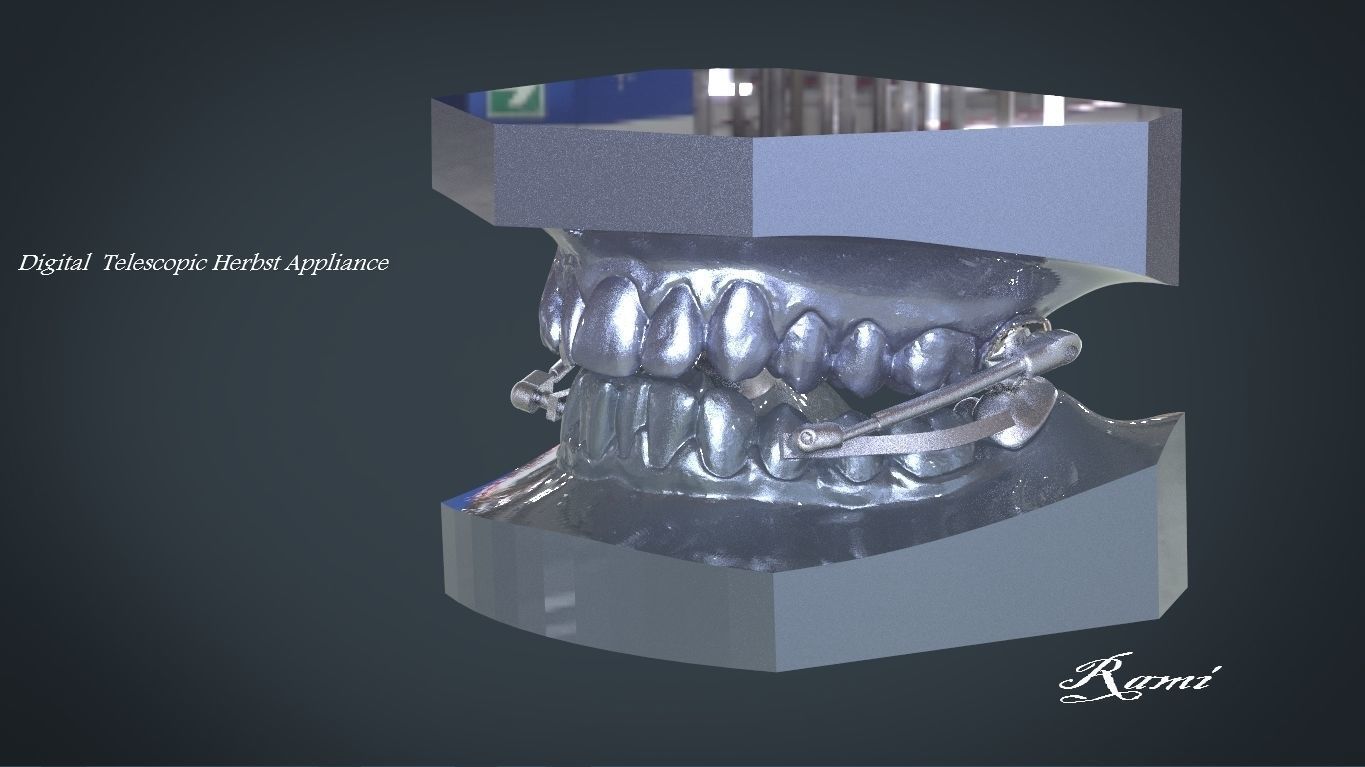 digital telescopic herbst appliance dental rhino3d cad tooth orthodontics 3shape keyshot 3dprinting lasersintering scanned models science 3D print model - Mito3D