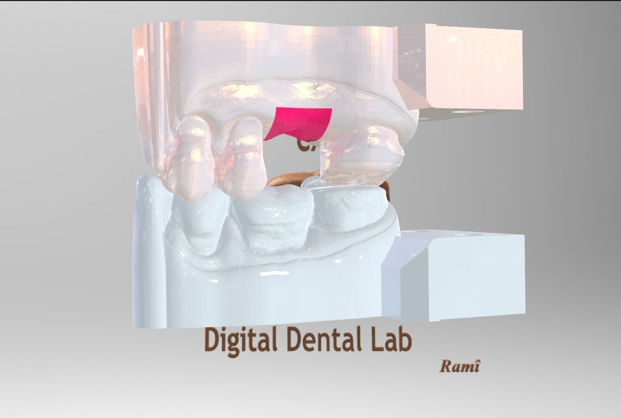 digital ti base widerlager modell dental cad implantieren 3d 3shape wissenschaft 3D print model - Mito3D